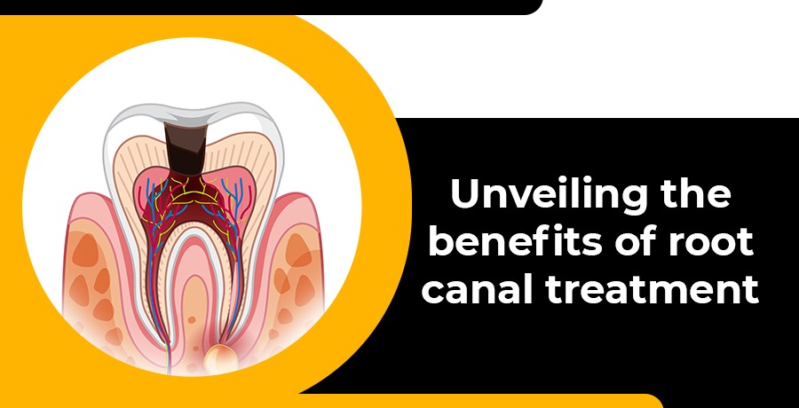 Unveiling the Benefits of Root Canal Treatment