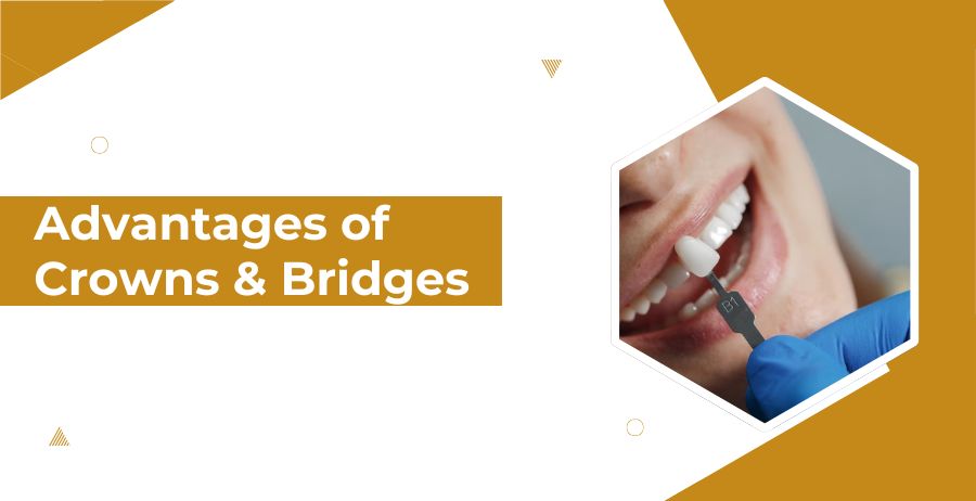 Advantages of Crowns and Bridges