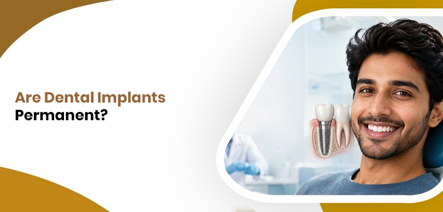 Are Dental Implants Permanent