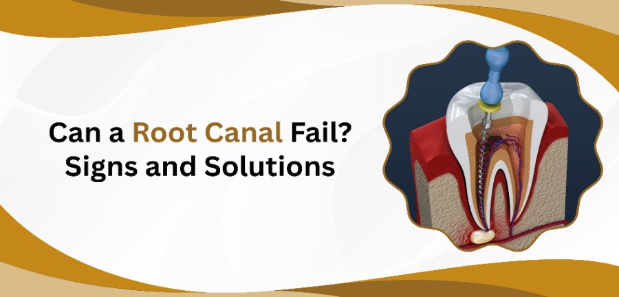 Can a Root Canal Fail