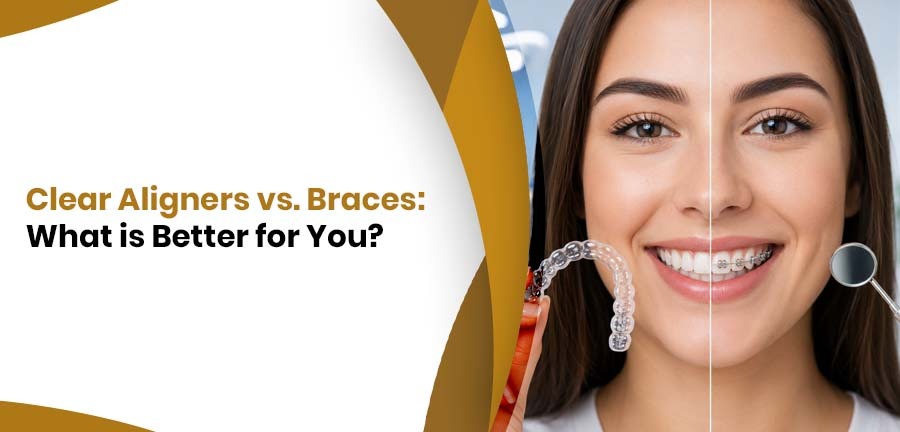Clear Aligners vs. Braces