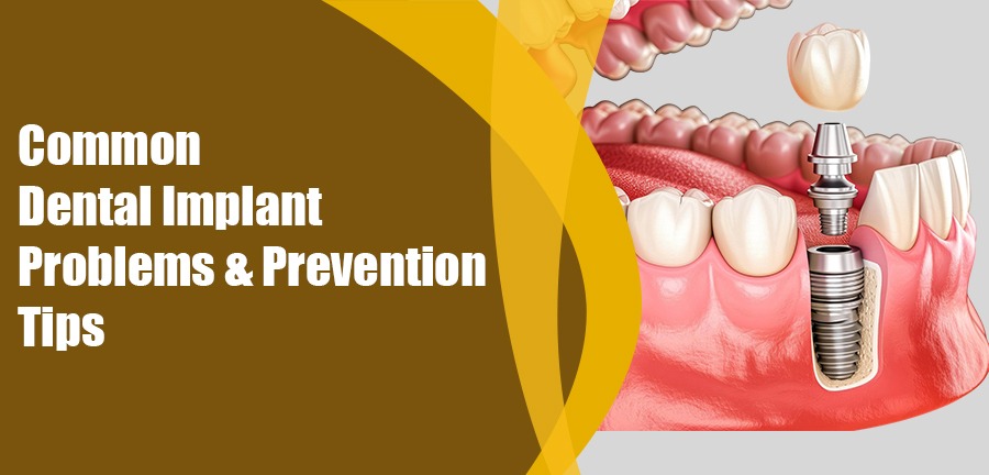 Common Dental Implants Problems and Prevention Tips