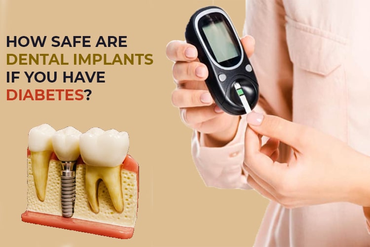 Dental Implants for diabetic