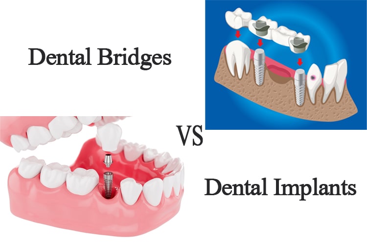 Dental Implants VS Dental Bridges