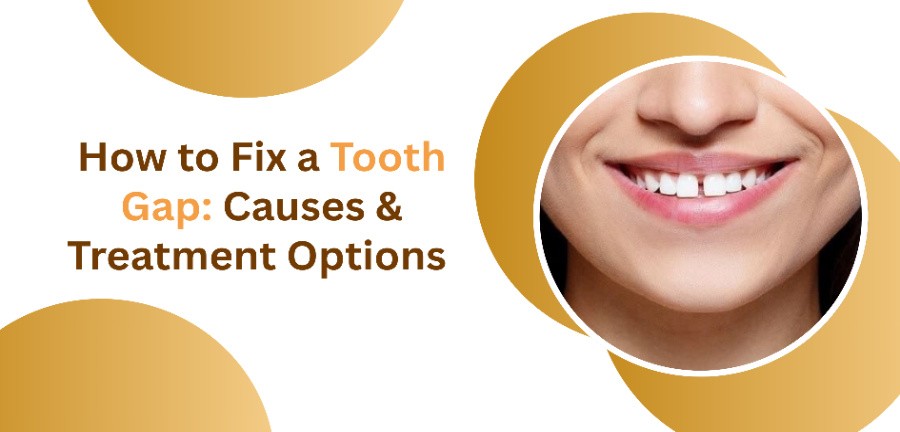 How to Fix a Tooth Gap