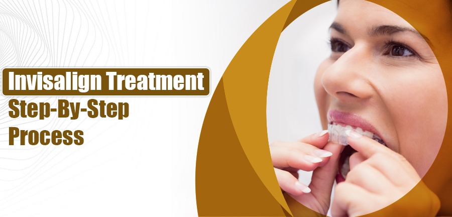 Invisalign Treatment: Step-By-Step Process