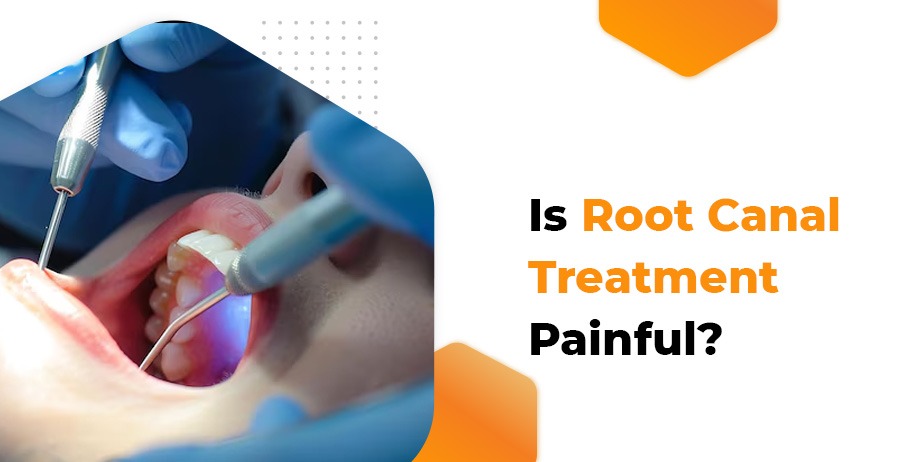 Is Root Canal Treatment Painful