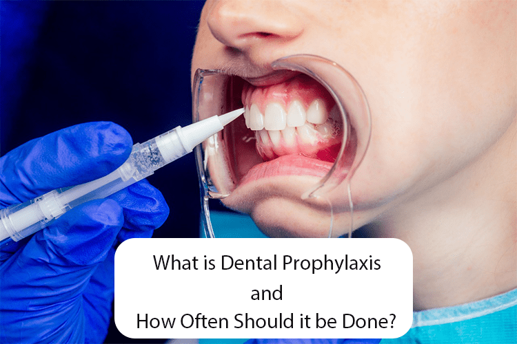 What Is Dental Prophylaxis And How Often Should It Be Done