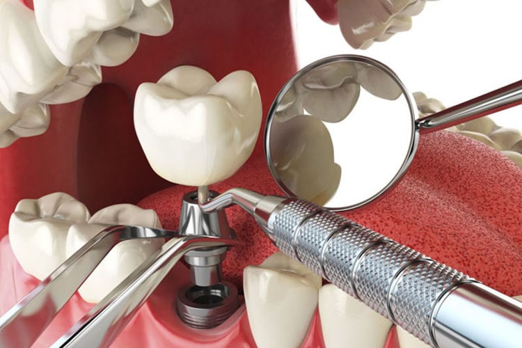 Dental Implants recovery