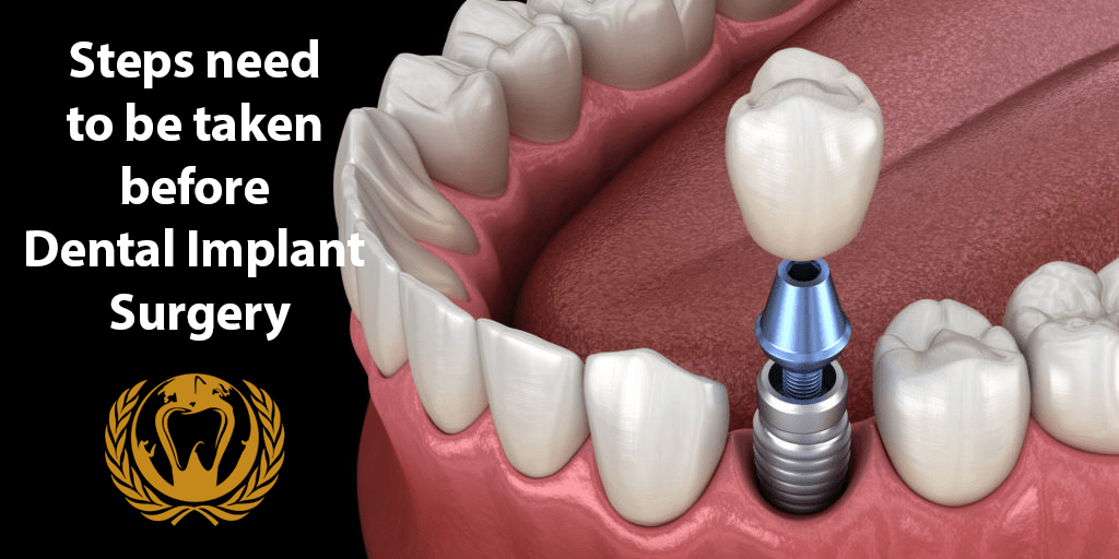 steps-need-dental-implant-surgery