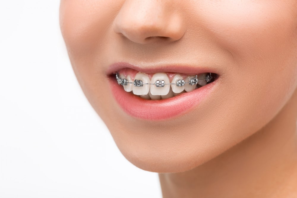 teeth-braces
