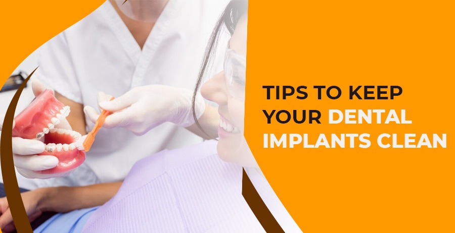 Keep your Dental Implants Clean