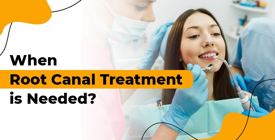 when Root Canal treatment is needed