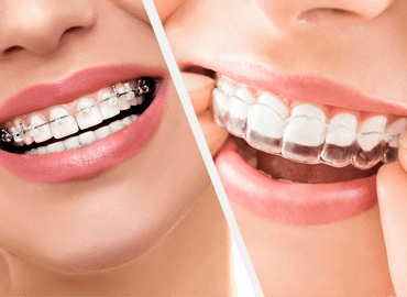 Aligners and Braces