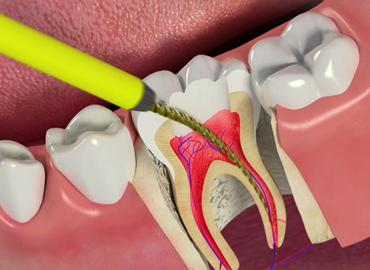 ROOT CANAL IN GURGAON